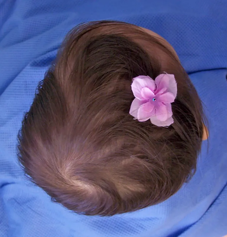 Lambdoid-r-preop-ara