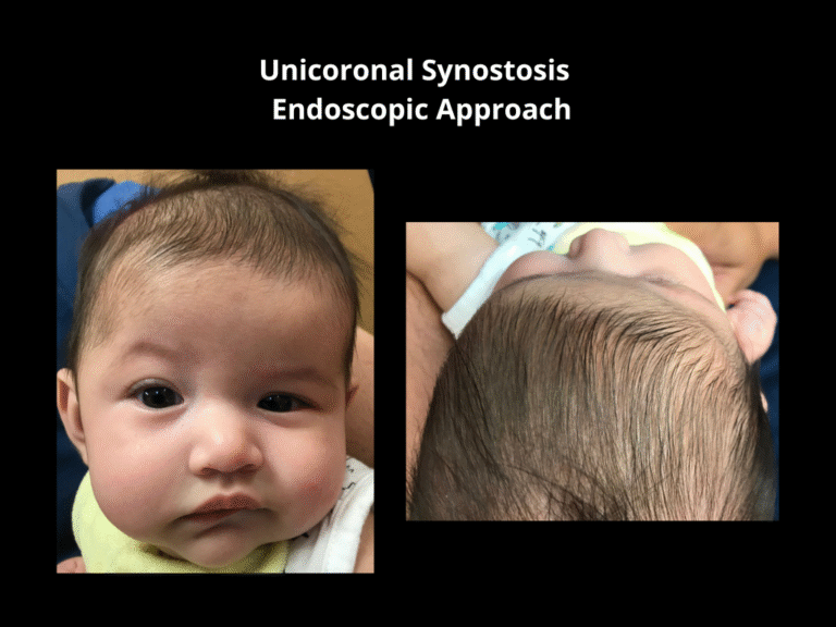 118 Right Unicoronal Synostosis