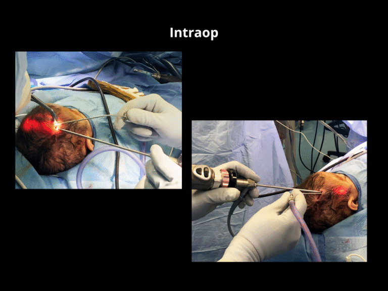 120 Right Unicoronal Synostosis