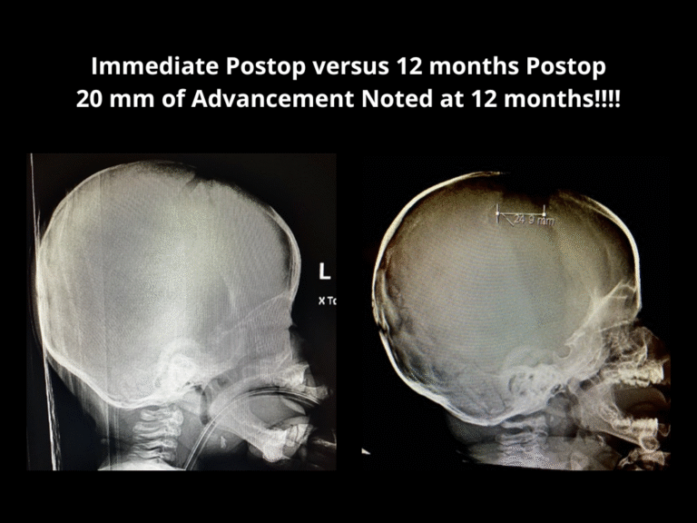 121 Right Unicoronal Synostosis