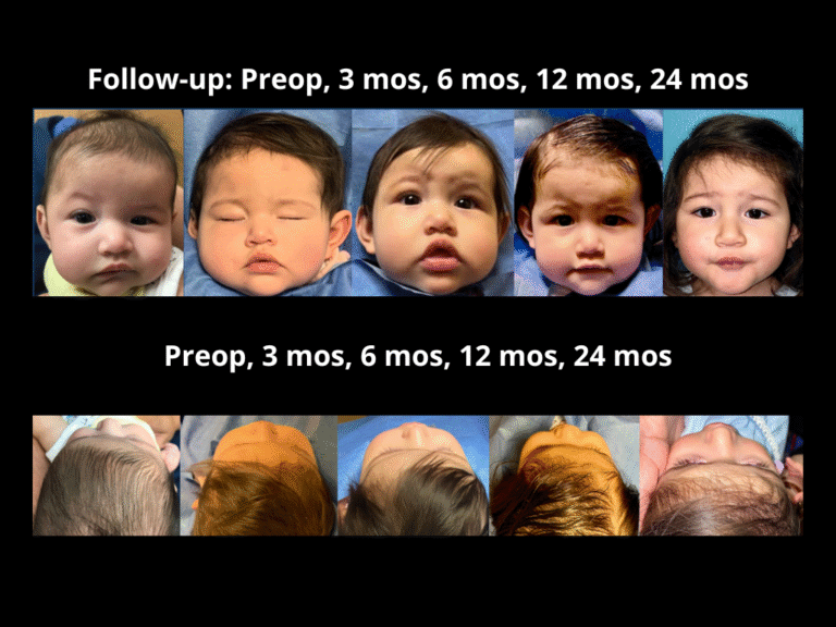 122 Right Unicoronal Synostosis