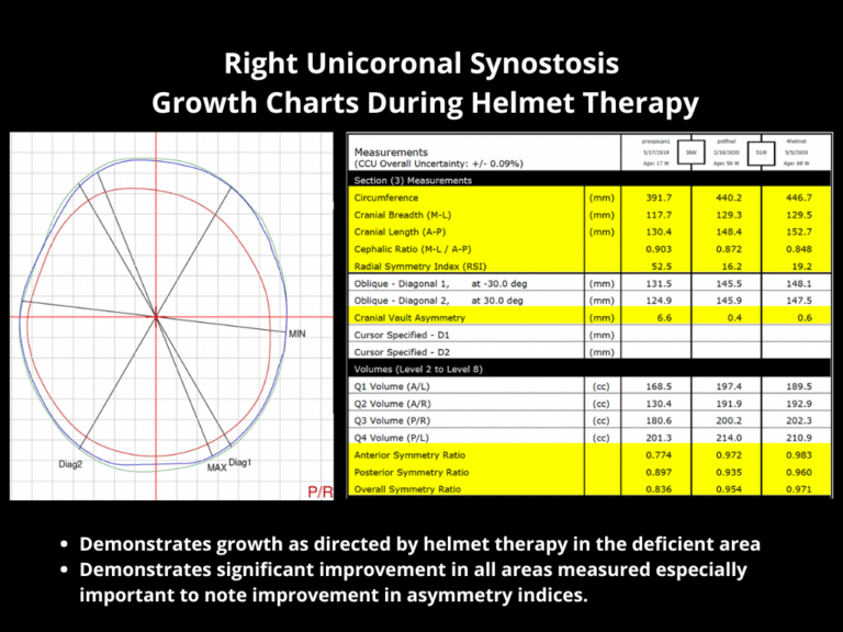124 Right Unicoronal Synostosis