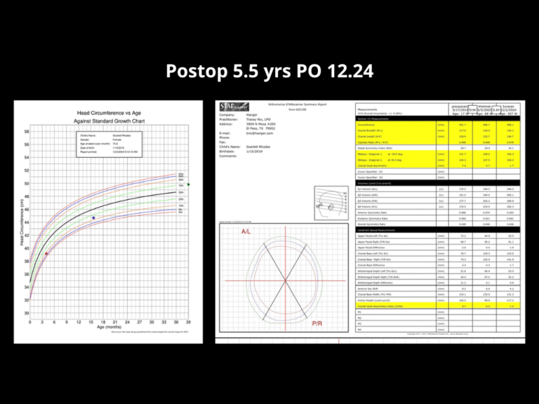 125 Right Unicoronal Synostosis