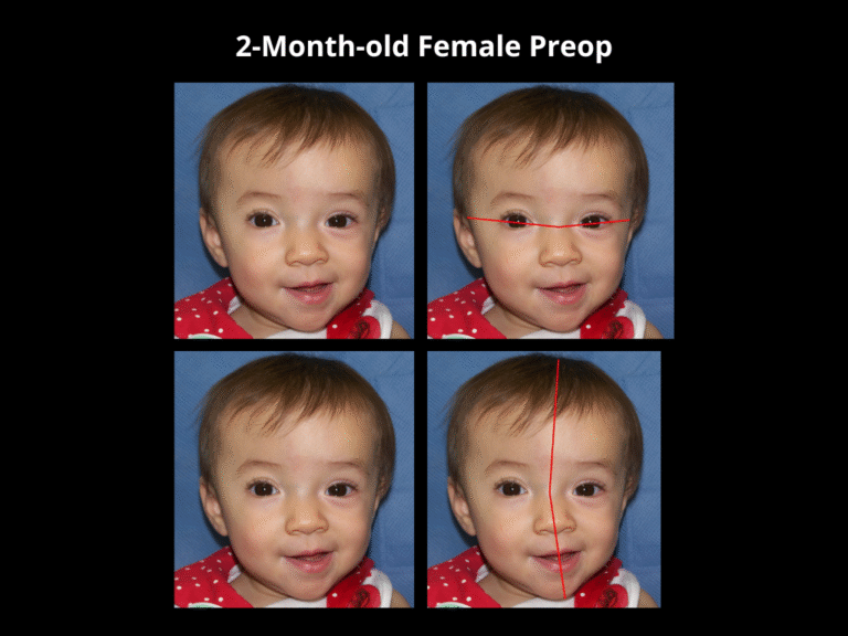 126 Right Unicoronal Synostosis