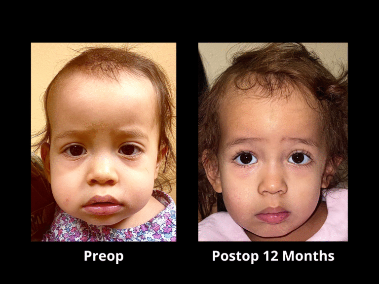 18 Right Unilateral Lambdoid Synostosis