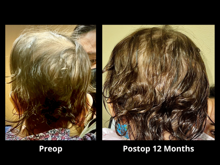 19 Right Unilateral Lambdoid Synostosis