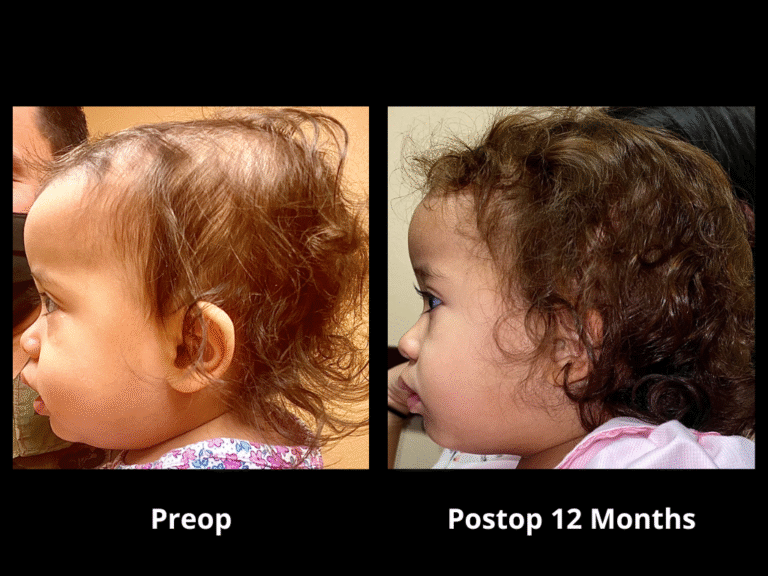 20 Right Unilateral Lambdoid Synostosis