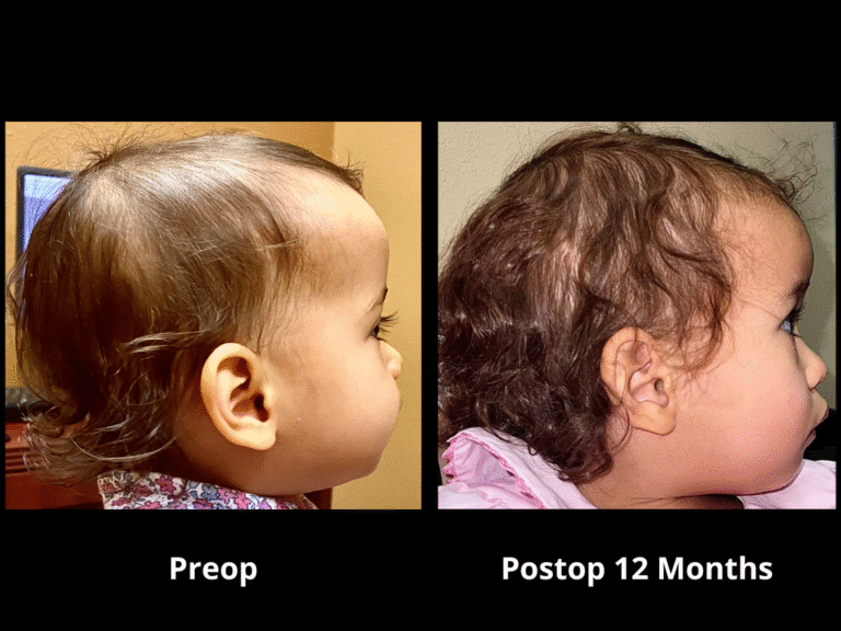 21 Right Unilateral Lambdoid Synostosis