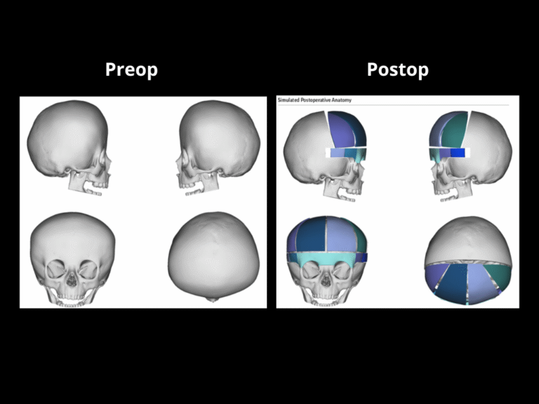 55 Bicoronal Craniosynostosis