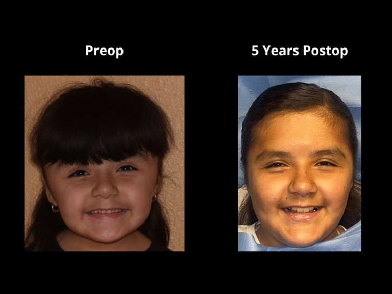 56 Bicoronal Craniosynostosis