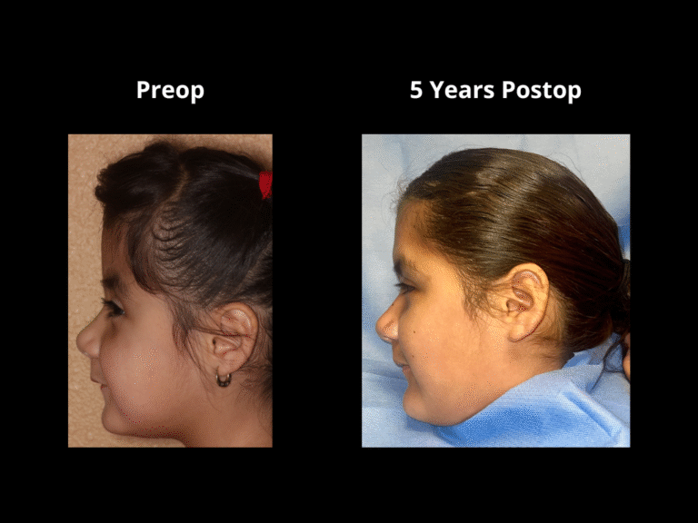57 Bicoronal Craniosynostosis