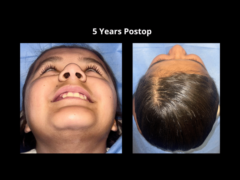 58 Bicoronal Craniosynostosis