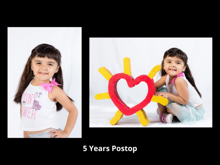 59 Bicoronal Craniosynostosis