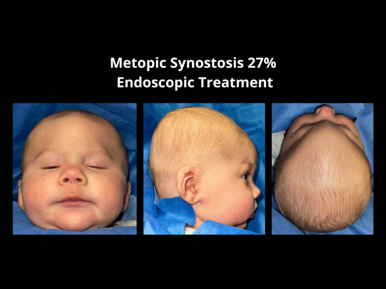 68 Endoscopic Treatment