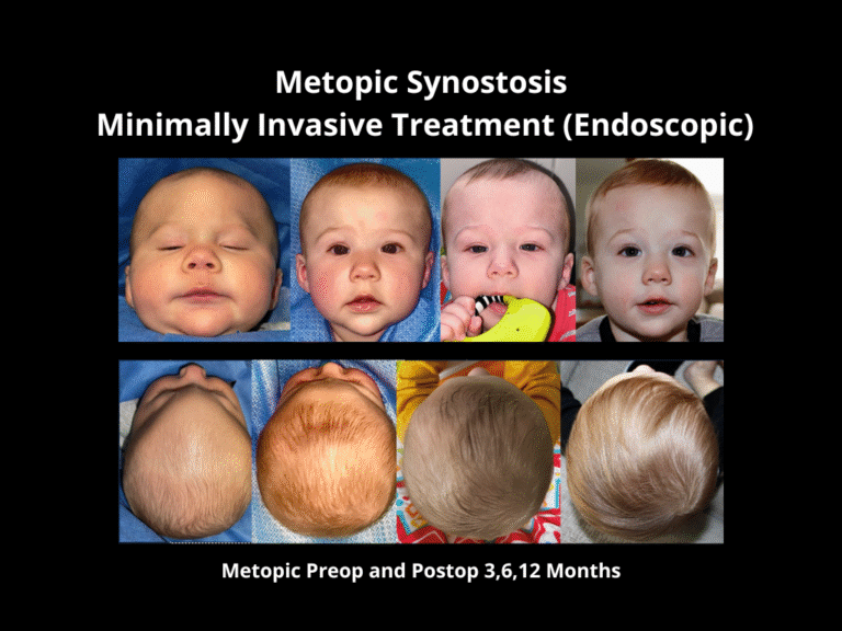 72 Endoscopic Treatment