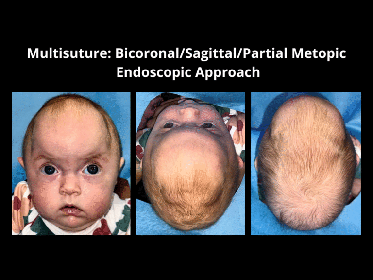 91 BicoronalSagittalPartial Metopic