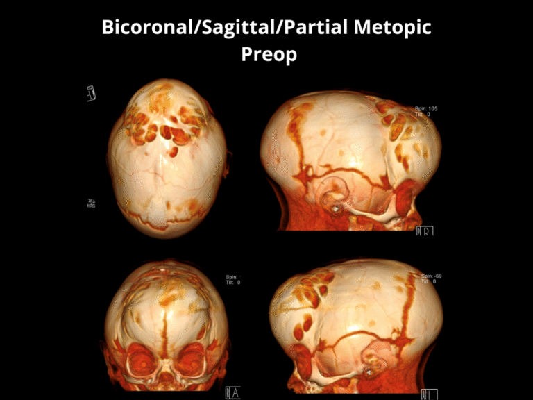 93 BicoronalSagittalPartial Metopic