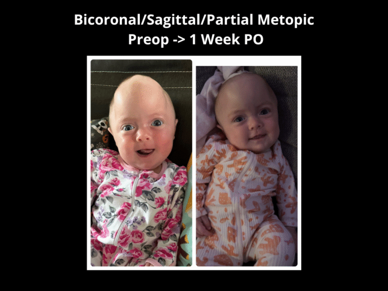 94 BicoronalSagittalPartial Metopic