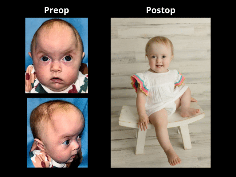 95 BicoronalSagittalPartial Metopic