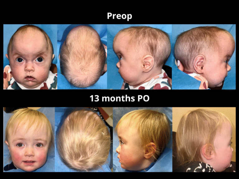 96 BicoronalSagittalPartial Metopic