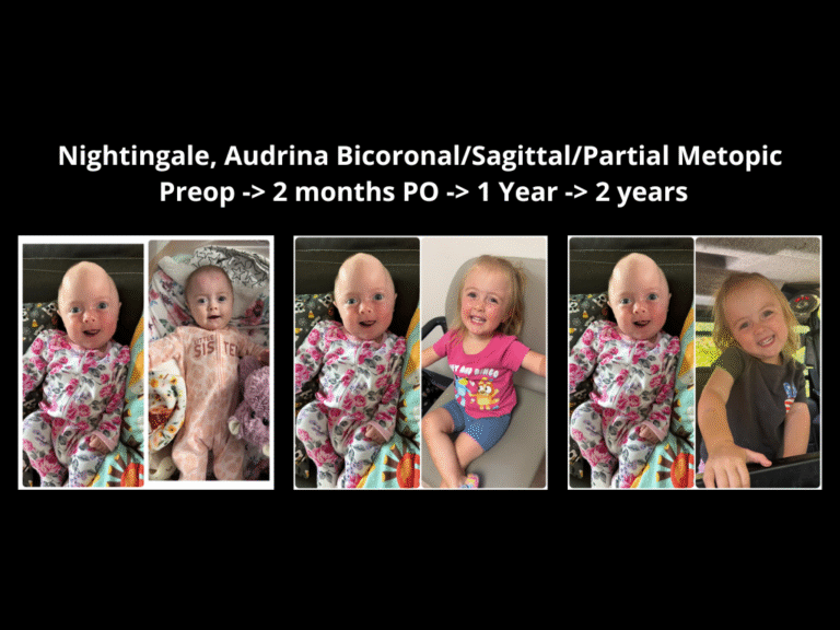 98 BicoronalSagittalPartial Metopic
