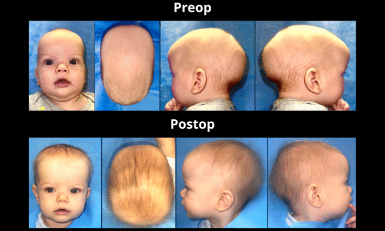 Parker Preop and Postop