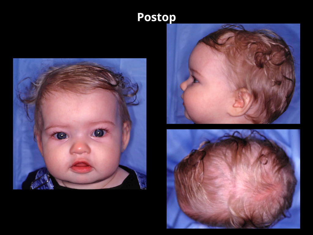 Postop 23
