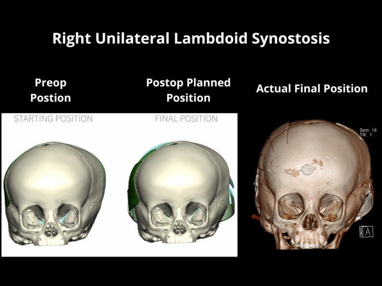 Right Unilateral Lambdoid Synostosis (1)