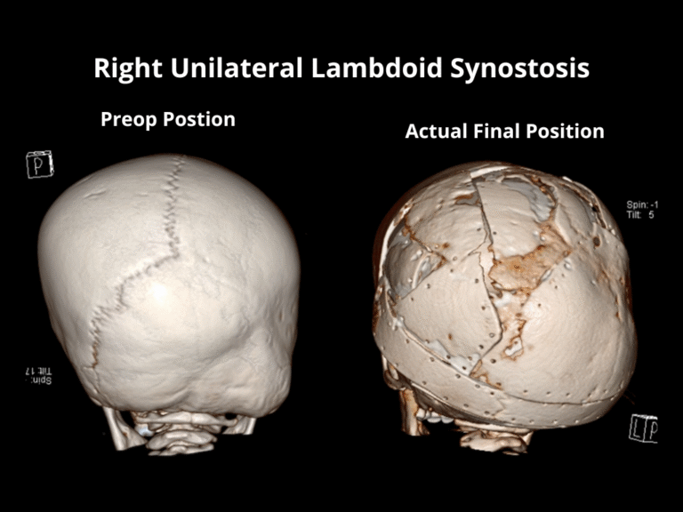Right Unilateral Lambdoid Synostosis (2)