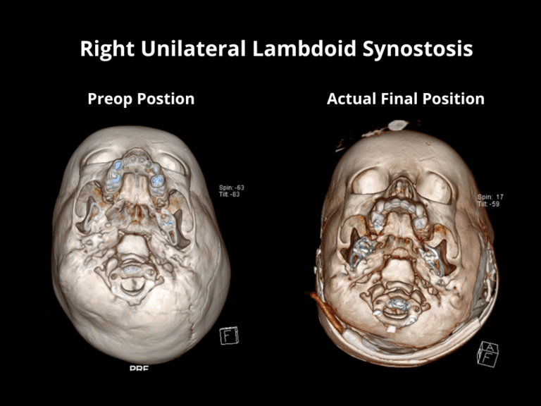 Right Unilateral Lambdoid Synostosis (4)