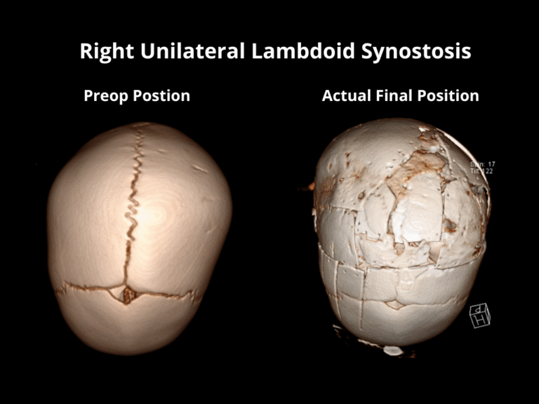 Right Unilateral Lambdoid Synostosis (5)